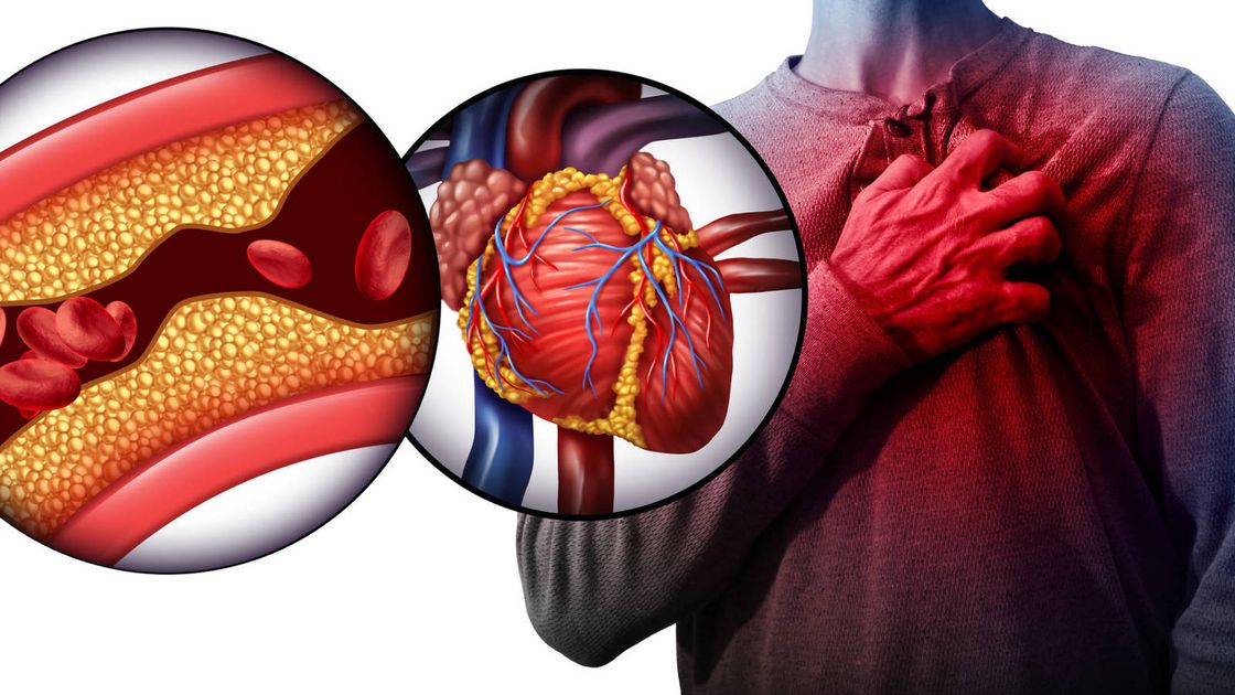 Colesterol alto avanza sin síntomas: la importancia del análisis de sangre