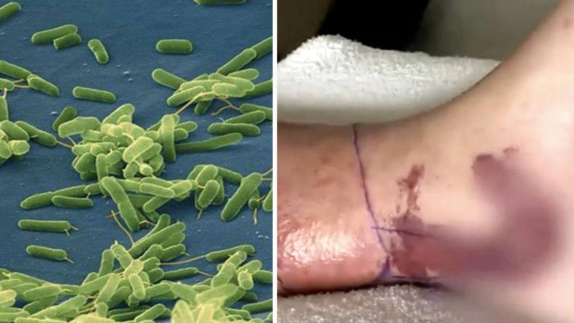 Bacteria necrosante aumenta mortalidad en EE.UU.; Ecuador refuerza vigilancia sanitaria